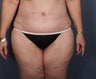 Body lift