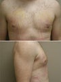 Male breast reduction
