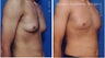 Male breast reduction
