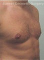 Male breast reduction