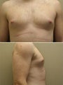 Male breast reduction