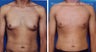 Male breast reduction