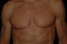Male breast reduction