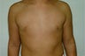 Male breast reduction
