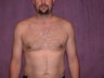 Male breast reduction