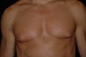 Male breast reduction