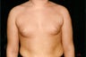 Male breast reduction