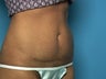 Mini tummy tuck