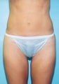 Mini tummy tuck