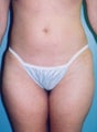 Mini tummy tuck