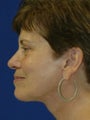 Neck lift