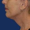 Neck lift