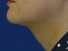 Neck lift