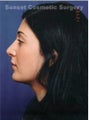 Neck lift