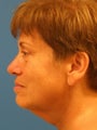 Neck lift