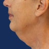 Neck lift