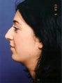 Neck lift