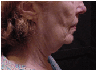 Neck lift