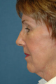 Neck lift