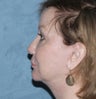 Neck lift