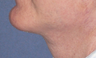 Neck lift