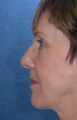 Neck lift