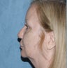 Neck lift