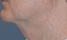 Neck lift