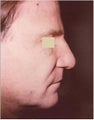 Non surgical nose job