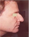 Non surgical nose job