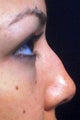 Non surgical nose job