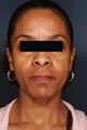 Non surgical Face lift