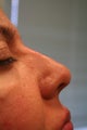 Non surgical nose job