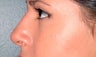 Non surgical nose job
