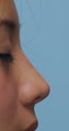 Non surgical nose job