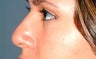 Non surgical nose job