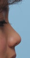 Non surgical nose job