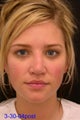 Rhinoplasty
