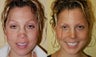 Nose surgery
