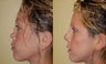 Nose surgery