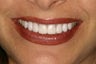 Porcelain veneers