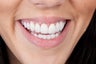 Porcelain veneers