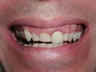 Porcelain veneers