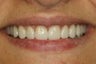 Porcelain veneers