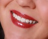 Porcelain veneers