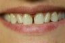 Porcelain veneers
