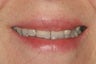 Porcelain veneers