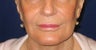 Restylane