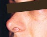 Restylane