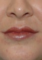 Restylane
